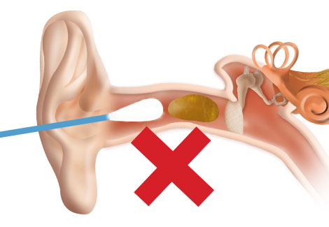 Die Verwendung von Wattestäbchen schiebt das Cerumen noch  tiefer ins Ohr