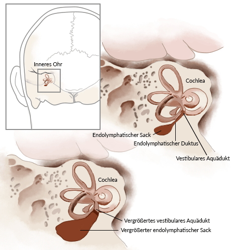 Pendred-Syndrom - unterentwickelten (hypoplastischen) Cochlea